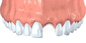 Upper teeth with a front tooth missing