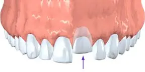 a tooth pushed back into its socket