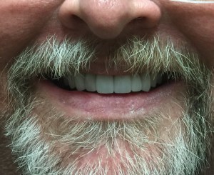 Man with a bright, even smile after dental crowns