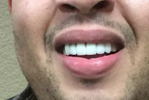 Bright, even smile after dental crowns