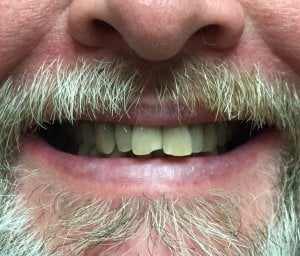 Man with a chipped front tooth