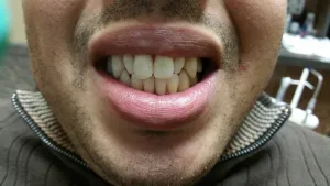 Uneven and dull teeth